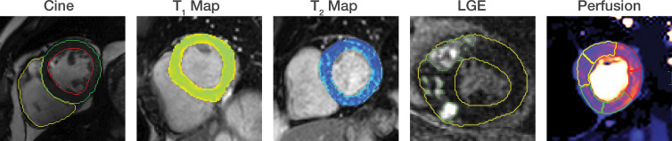 Automated segmentation using convolutional U-Net convolutional neural networks. Automated segmentation based on U-Net architectures has been demonstrated across many cardiac MRI sequences, including cine, T1 and T2 mapping, late gadolinium enhancement (LGE), and perfusion images.