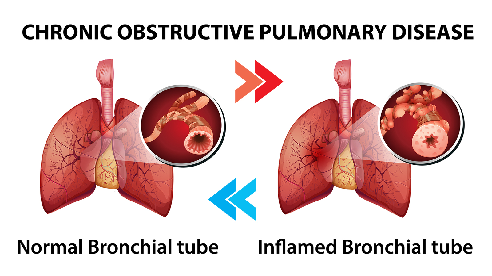 Exercises for COPD