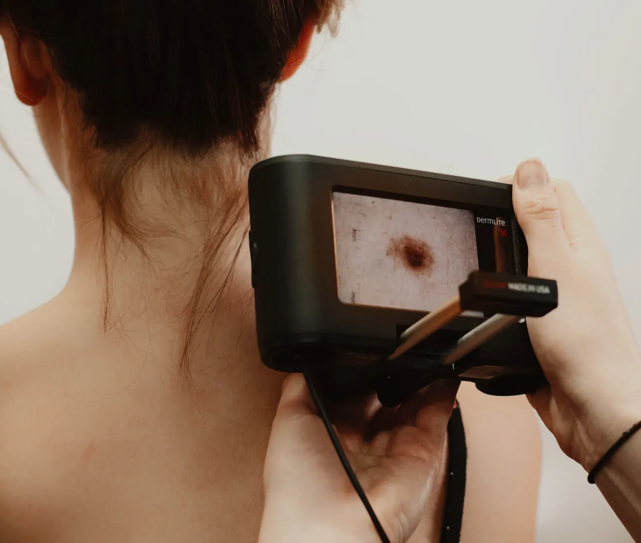 A melanographer will check your skin and image any suspect moles