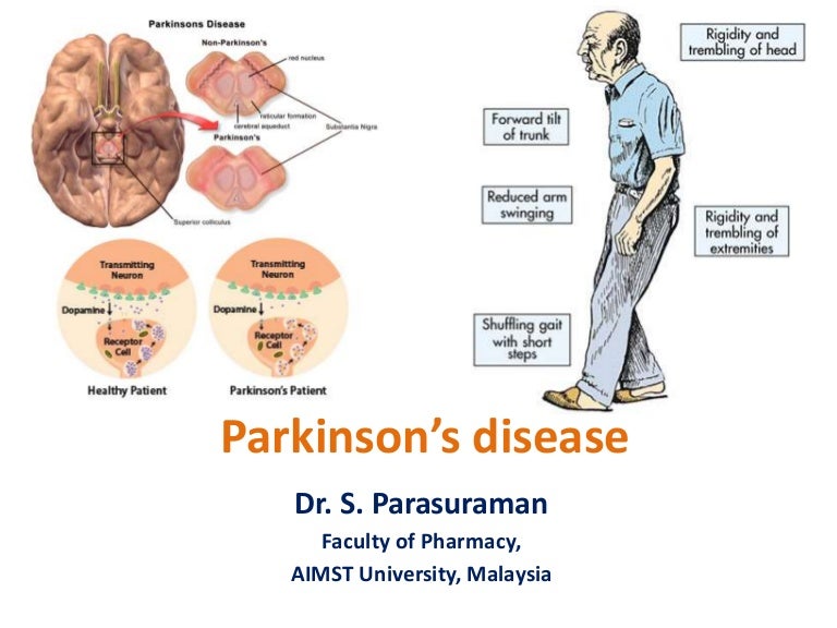 Parkinson's Disease Diagram