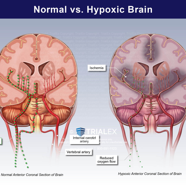 Normal vs Hypoxic Brain