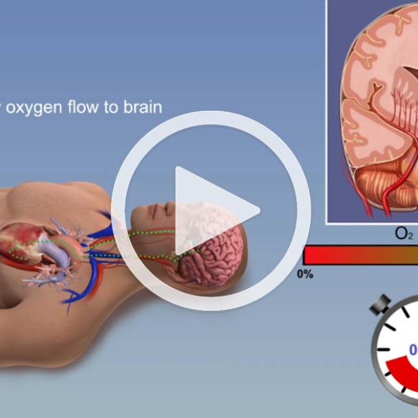 Cerebral Hypoxia