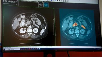 揪早期癌病灶  AI智慧醫療立功！  