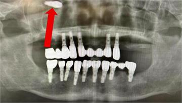 植牙體掉進鼻竇腔作祟　害男鼻腔發臭、頭痛