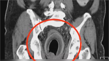 「直腸卡一顆椰子！」56歲男痛爆掛急診 醫剖腹取...