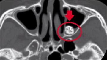 婦鼻涕見血絲誤鼻竇炎 就醫驚見「鼻腔長牙」