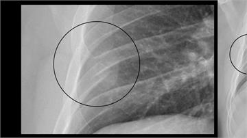 民眾咳到胸痛就醫！ X光一照驚見「肋骨斷裂」