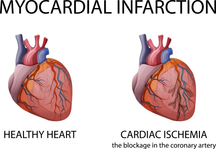 Heart myocardial infarction vector image