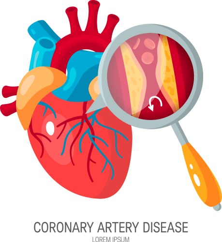 Coronary artery disease concept in flat style vector image