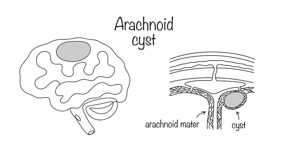 Arachnoid cyst vector image