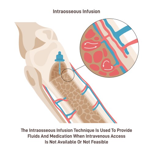 Intraosseous injection technique process vector image