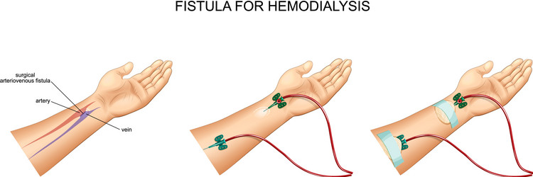 intravenous catheter hemodialysis and fistula vector image