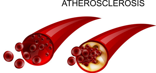 healthy vessel and atherosclerotic vector image