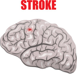 a hemorrhagic stroke vector image