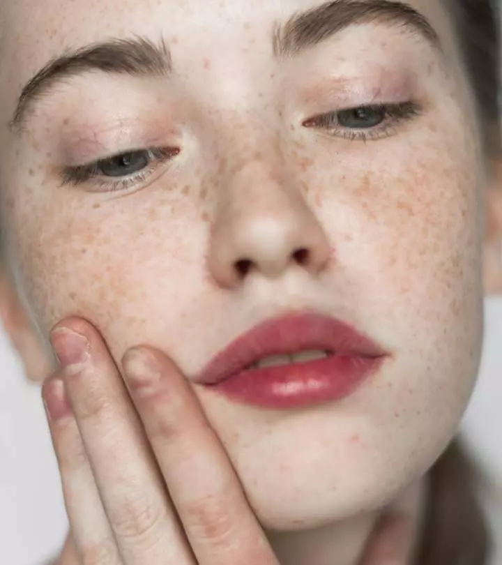 Woman With Hyperpigmentation Around Mouth