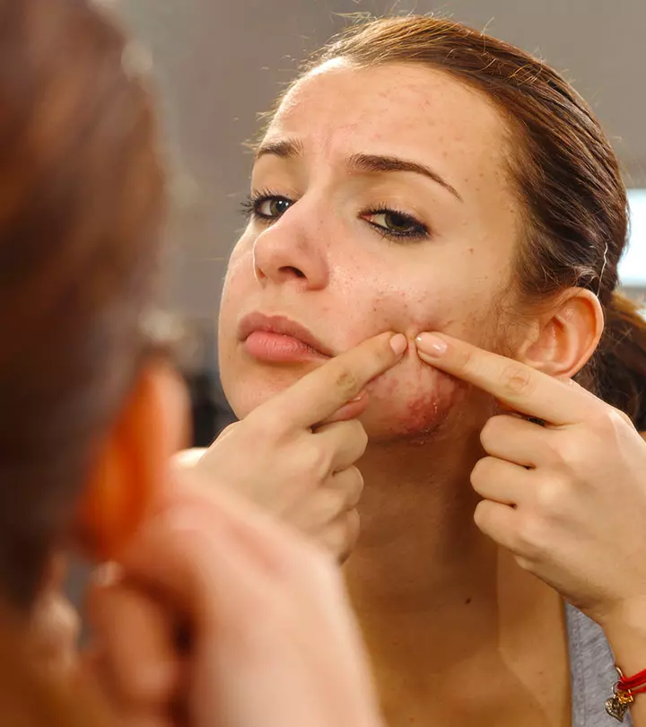 Comedonal Acne: Causes, How To Treat It, & Ways To Prevent It