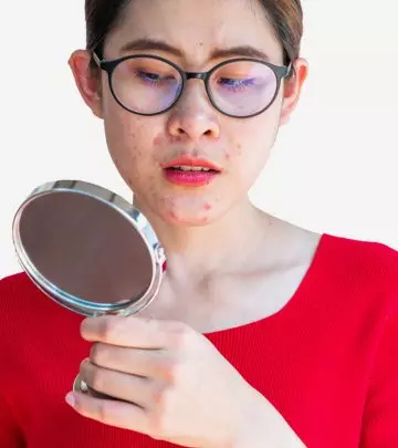 Woman With Hyperpigmentation Around Mouth