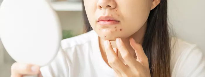 Woman with rashes around her mouth