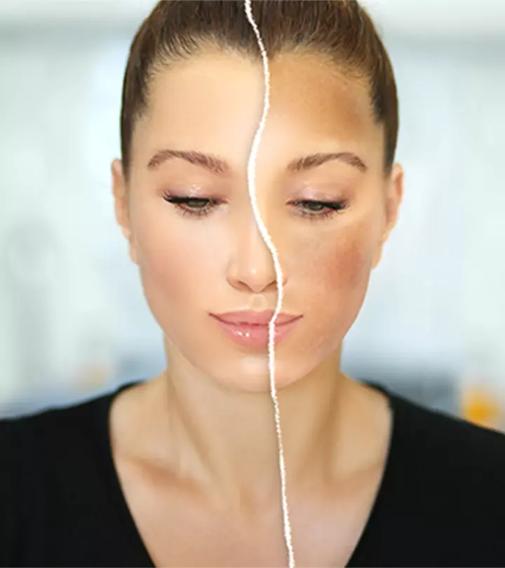 Woman With Hyperpigmentation Around Mouth