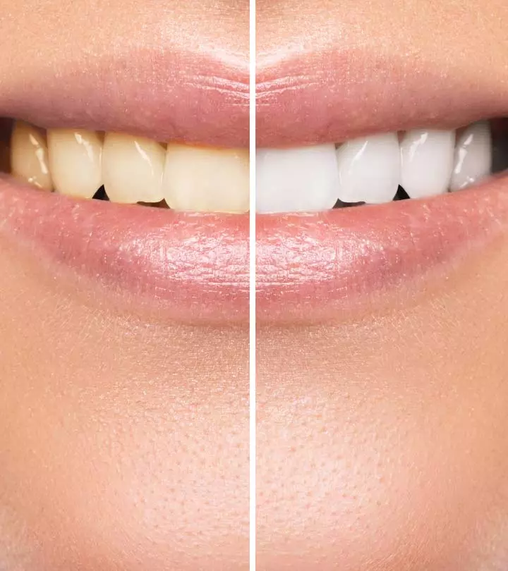 11 Habits That Are Staining Your Teeth_image