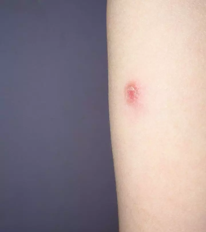 Woman Suffering From Herpes On Skin