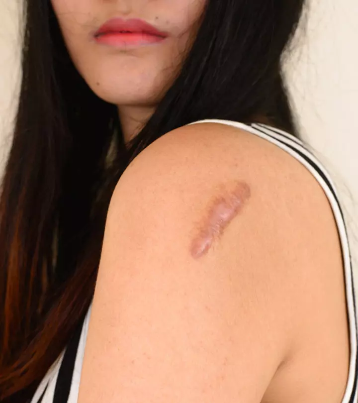 Woman Suffering From Herpes On Skin