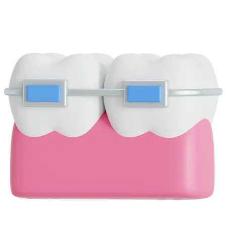 Braces  3D Icon