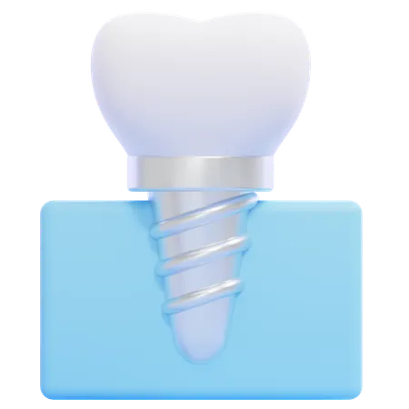 Dental Implant  3D Icon