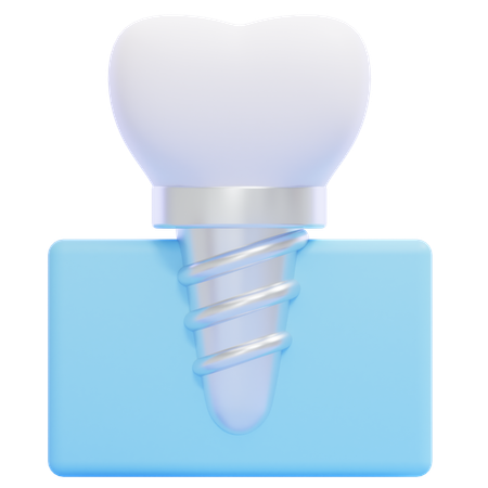 Dental Implant  3D Icon