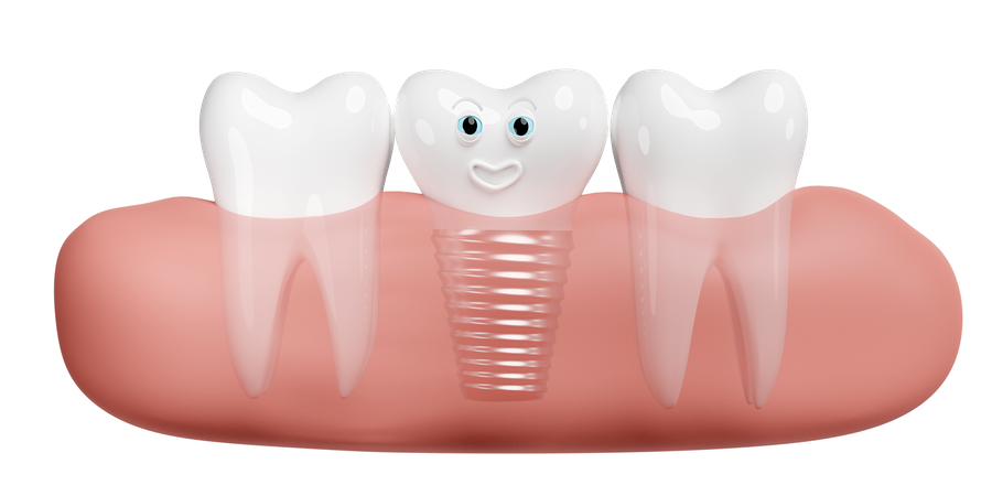 Encía con implante dental  3D Illustration