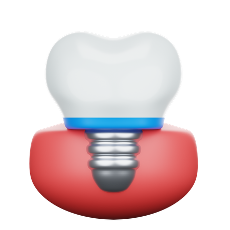 Implante dental  3D Icon