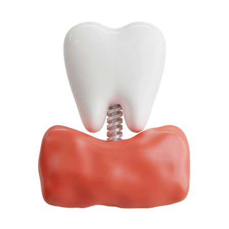 Implante dental  3D Icon