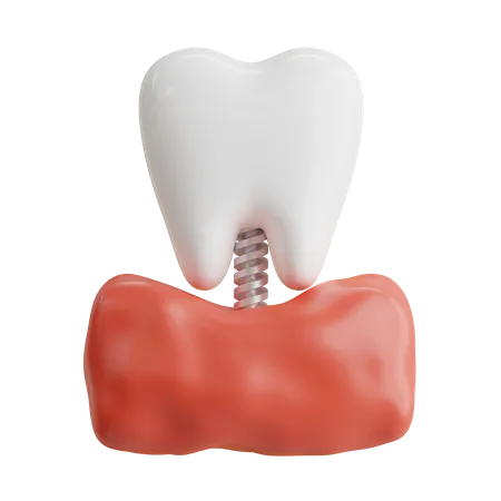 Implante dental  3D Icon