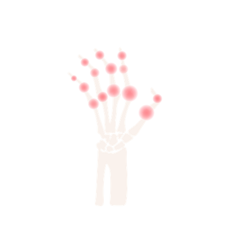 Arthritis Hand Rheumatoid Disease  Illustration