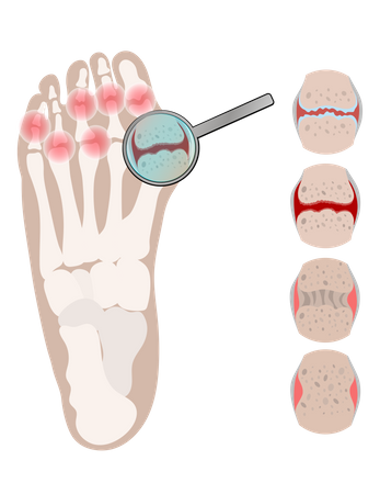 Arthritis Leg Rheumatoid Chronic Disease  Illustration