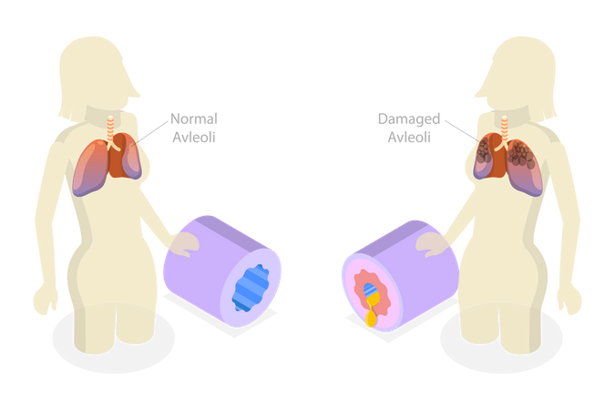 Chronic Obstructive Pulmonary Disease  Illustration