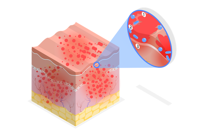 Dermatite atópica  Ilustração