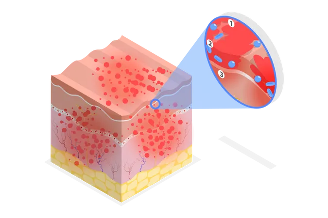 Dermatite atópica  Ilustração