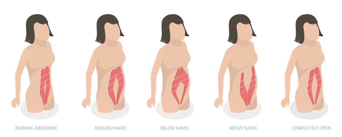 Diastasa de los músculos abdominales y problema de las mujeres después del embarazo  Ilustración