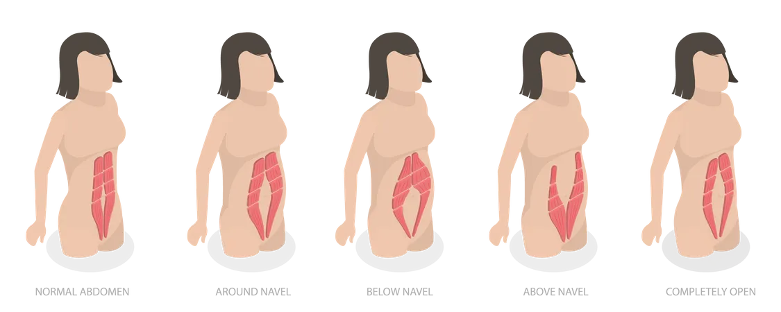 Diastase musculaire abdominale et problème chez les femmes après la grossesse  Illustration