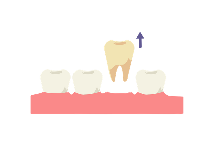 Extraction dentaire  Illustration