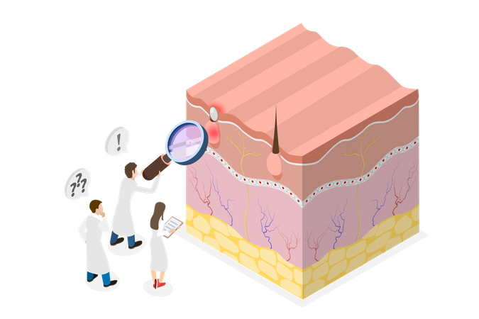 Formação de espinha na pele  Ilustração