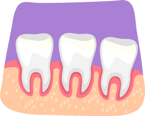 Inflamación de los dientes  Ilustración