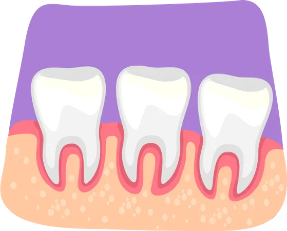 Inflamación de los dientes  Ilustración