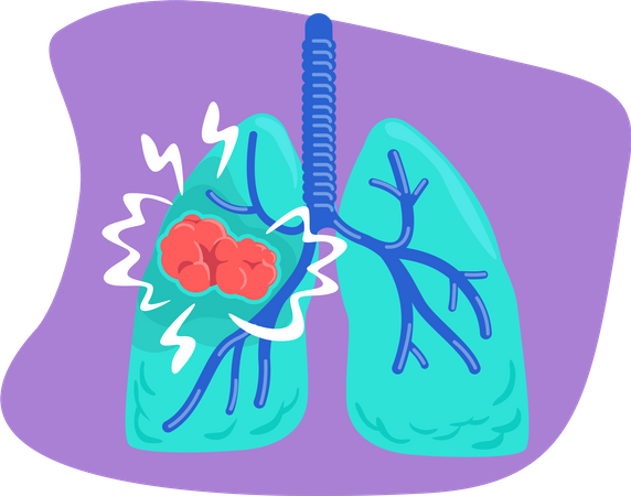 Lung cancer  Illustration