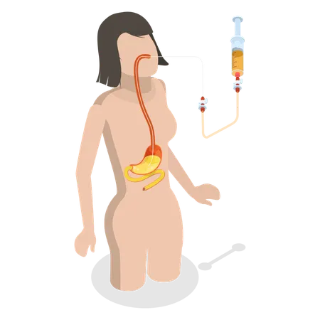 Nasogastric Tube Passed Through Nose to Stomach  Illustration