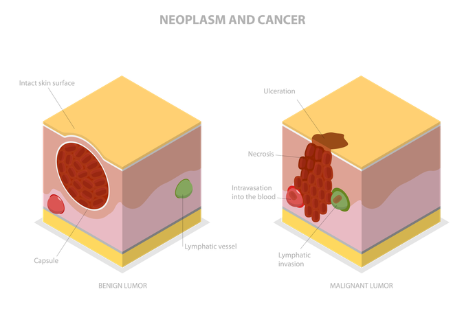 Neoplasm And Cancer  Illustration