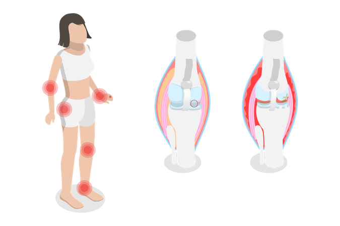 Osteoarthritis and Rheumatoid Arthritis  Illustration