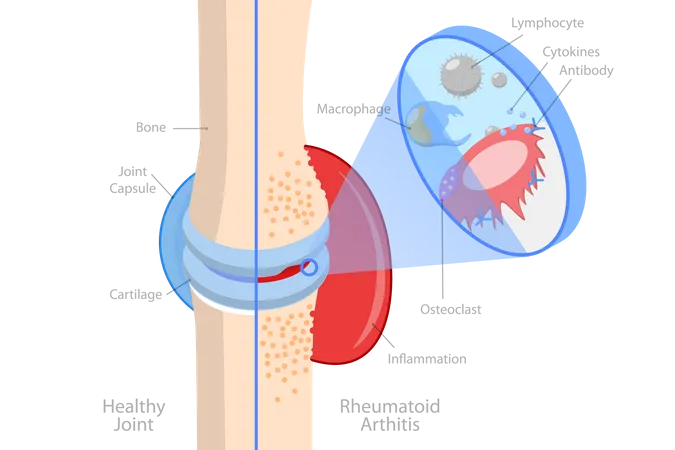 Rheumatoid Arthritis  Illustration