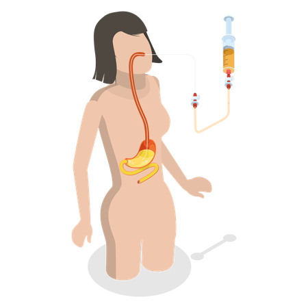 Sonda nasogástrica que pasa desde la nariz hasta el estómago  Ilustración